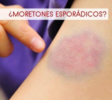 Leucemia CIDTES Hematólogo en Quito2